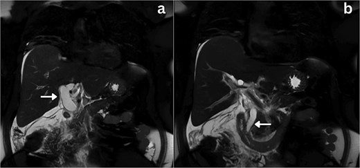 Coronal section MRCP imaging; a) Gross biliary dilatation (arrow), b) smooth tapering of the bile duct with no evidence of stones (arrow).