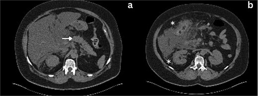 Axial section CT imaging; a) Normal pancreas with no evidence of inflammation or malignancy (arrow), b) extrahepatic biliary collection (asterisks).