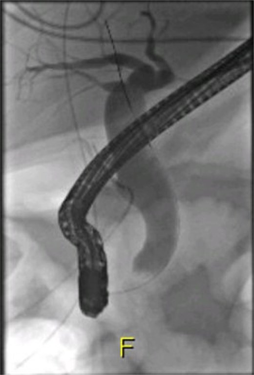 ERCP imaging reveals contrast leak in the cystic duct stump region.