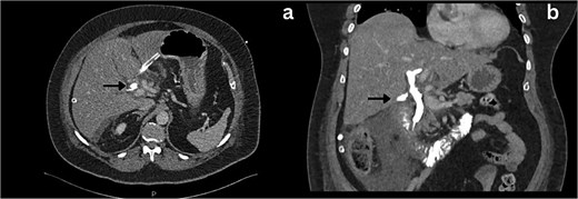 Axial and coronal section CT imaging revealing contrast leak from the bile duct; a) Contrast leak from the posterior aspect of CBD (arrow). b) Contrast extravasation into the subhepatic drain (arrow).