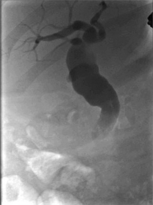 ERCP imaging after stent removal depicting no contrast leak.