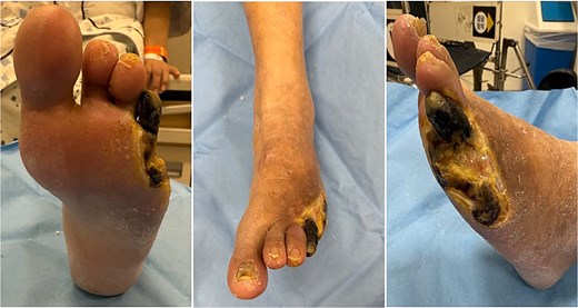 Clinical photograph of the left foot on initial presentation at our institution.