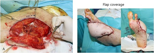 Intraoperative photographs of the ALT free flap procedure. (A) Donor site on the anterolateral thigh after flap harvest, showing the surgical field prior to closure. (B) Immediate postoperative view of the left foot following successful inset of the ALT free flap, with microvascular end-to-end anastomosis to the dorsalis pedis artery.