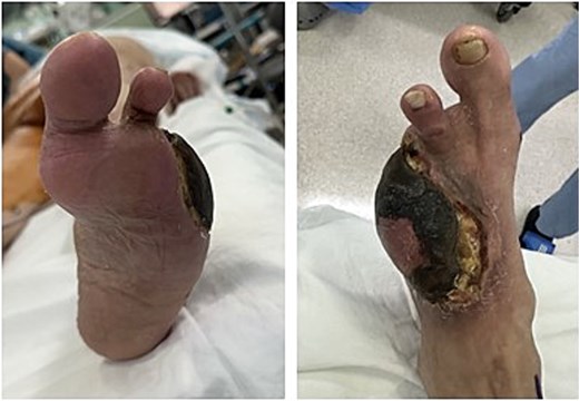 Clinical photograph of the left foot upon readmission three months after free flap reconstruction.
