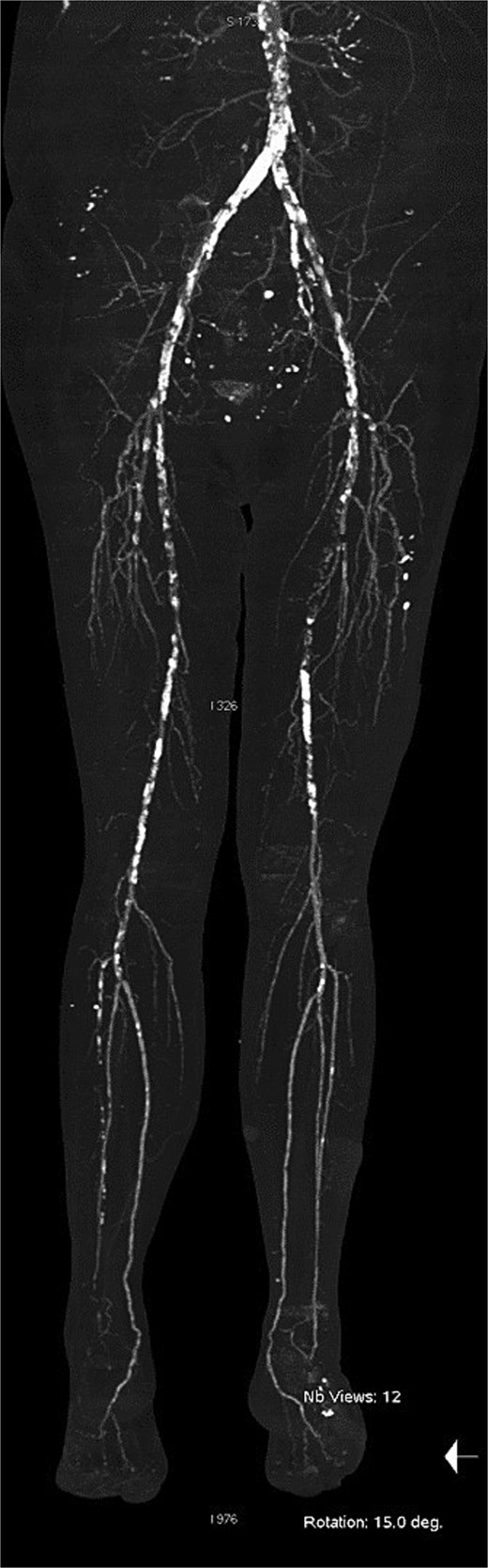 Computed tomography angiography at the time of readmission.
