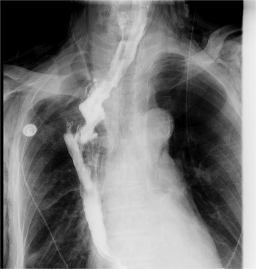 Upper gastrointestinal series performed during postoperative week 1.