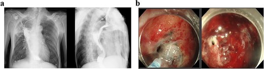(a) Upper gastrointestinal series obtained 2 months postoperatively. (b) Gastroscopic examination performed 2 months postoperatively.