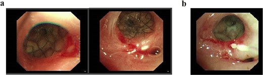 (a) Status following bronchoscopic stent placement. (b) Follow-up bronchoscopy demonstrating healed fistulous tract 2 weeks postintervention.