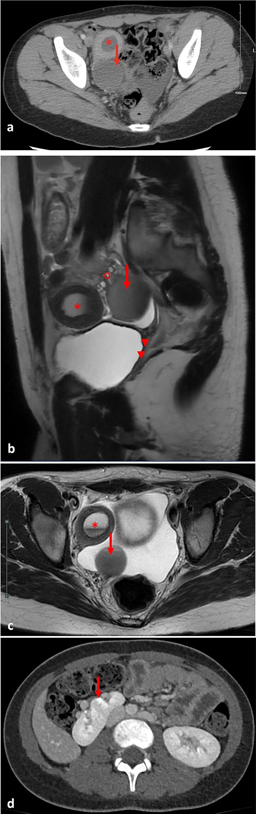 (a) Pre-operative axial computed tomography imaging, demonstrating a right uterine horn with hematometra (*) and a right adnexal cystic structure representing hematosalpinx (arrow). (b) Pre-operative pelvic parasagittal T2 weighted MRI, demonstrating a right uterine horn with hematometra (*), a right adnexal cystic structure representing hematosalpinx (arrow), normal right ovary (o), cervical aplasia, and vaginal atresia (arrowheads). (c) Pre-operative pelvic axial T2 weighted MRI, demonstrating a right uterine horn with hematometra (*), and a right adnexal cystic structure representing hematosalpinx (arrow). (d) Pre-operative abdominal axial T2 weighted MRI, demonstrating a right supernumerary kidney (arrow).