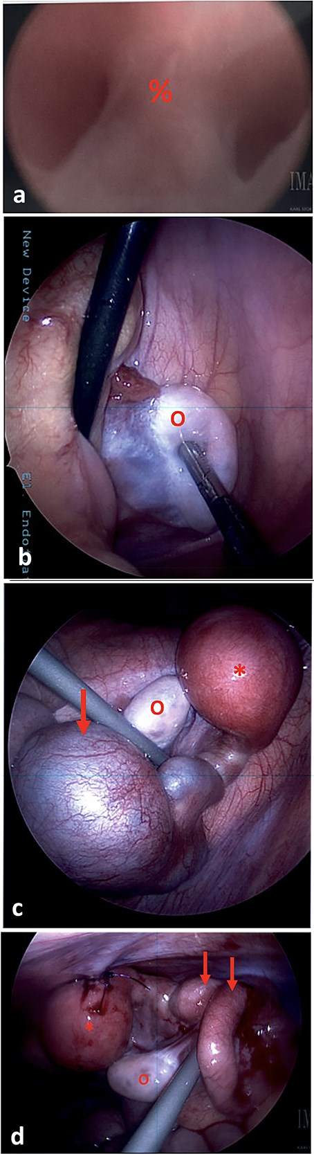 (a) On vaginoscopy, a central septum (%) was noted, suggestive of a longitudinal vaginal septum or hemi-vaginas. (b) Laparoscopic photograph showing the left ovary (o) located in the left lower pelvis, not attached to any tubal structure. (c) Laparoscopic photograph demonstrate a right-sided hypertrophic uterus (*), significantly dilated and firm due to retained blood, and a markedly dilated and tortuous right fallopian tube (arrow). The right ovary appeared normal (o). (d) The uterine dome (*) was sutured to the abdominal wall. The right fallopian tube was decompressed after aspiration (arrows).