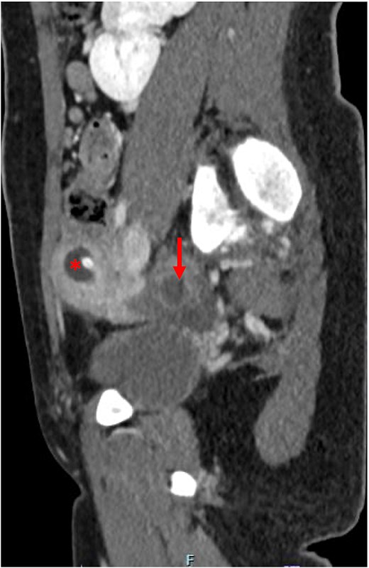 Post-operative computed tomography abdomen/pelvis demonstrating resolution of the hematometra (*) and improvement of the hematosalpinx (arrow).