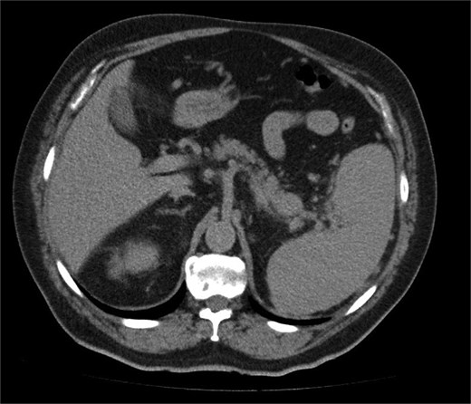 A contrast-enhanced CT scan of the abdomen (axial image) showing a soft tissue lesion in the pancreatic tail measuring 2.4 × 2.7 cm, radiologically suspicious for a primary pancreatic neoplasm.