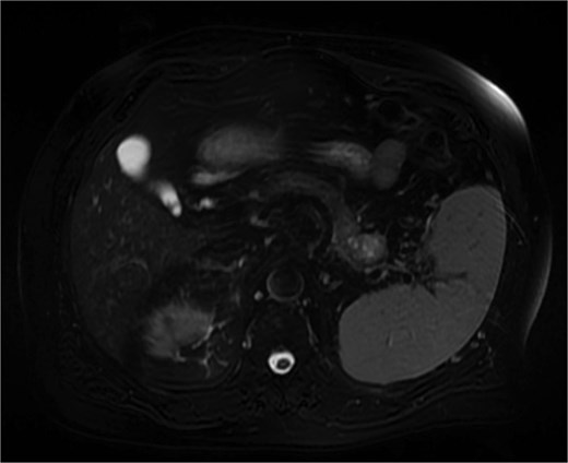 MRI (venous phase) shows a 2.6 cm lesion in the pancreatic tail, exhibiting heterogeneous T2 signal intensity with areas of high signal but lacking diffusion restriction.