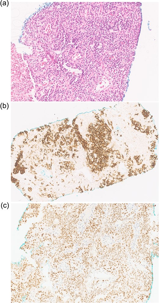 Biopsy shows (a) H&E scant cohesive clusters of polygonal epithelioid cells with clear cytoplasm. Immunohistochemistry positive for (b) CD10 and (c) PAX8, confirming metastatic RCC.