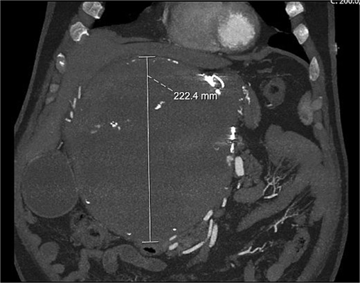 Coronal CT image showing large HAA.