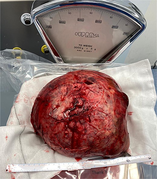 Large HAA post removal.