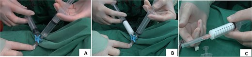 Preparation of polidocanol foam sclerosing agent.