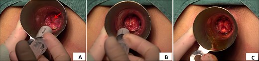 Injection method of polidocanol foam sclerosing agent. (A) Injection site of polidocanol foam sclerosant (indicated by arrow). (B) Injection treatment with polidocanol foam sclerosing agent. (C) Hemorrhoid foam sclerosing agent ids after injection treatment with polidocanol.