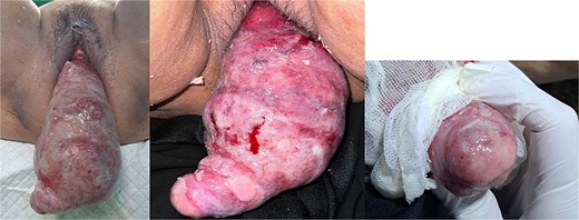 Uterine inversion with submucosal leiomyoma on the corpus. The mass was found to be eroded and covered with slough. A point-like structure was identified at the apex of the mass, suspected of being the tubal ostium; however, the opening of the cervical canal was not identified.