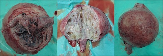 Submucous leiomyoma that was extracted from the uterus. It showed a cystic white degeneration with serous fluid inside.