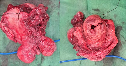 The uterus with the cervix. The corpus was already dissected and excised from the submucous leiomyoma.