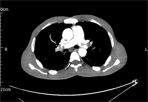 Contrast CT scan of the chest showing bilateral pulmonary artery thromboemboli (arrow heads).
