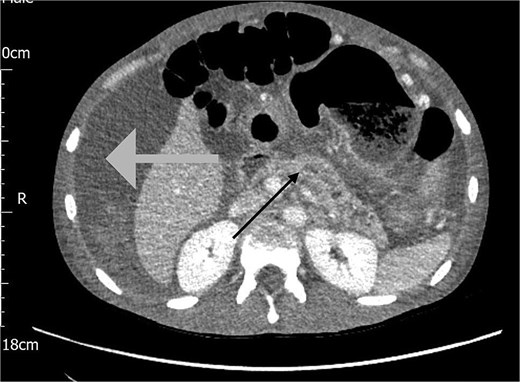 CT scan of the abdomen showing haemorrhagic ascites in the perihepatic area (grey arrow) and an irregular dilated pancreatic duct (black arrow).