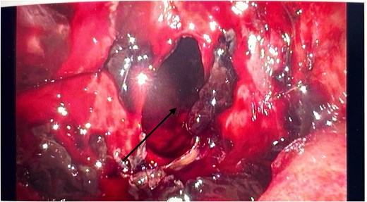 Intraoperative laparoscopic picture showing a haemorrhagic cavity in the retroperitoneum extending into the pancreas (black arrow).