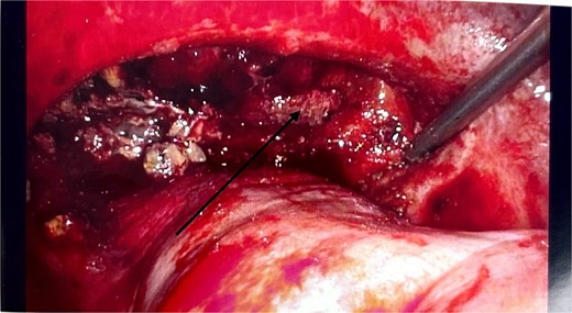 Intraoperative laparoscopic image showing the cavity packed with Surgicel haemostatic gauze (black arrow).