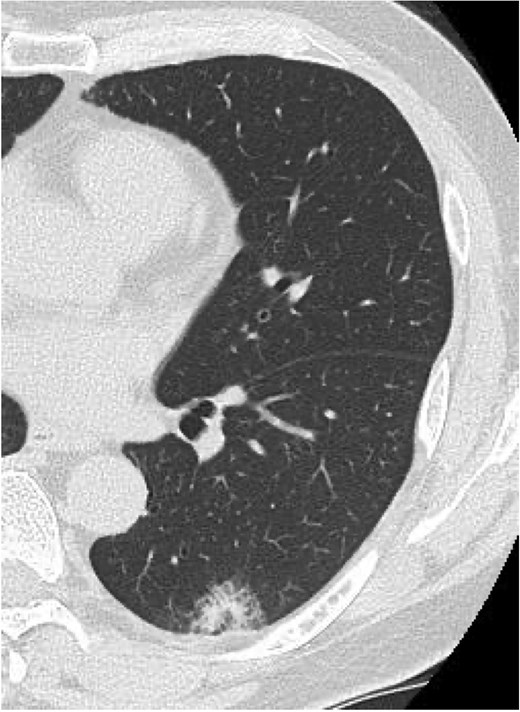 Preoperative chest computed tomography showing a 35 × 12 × 20 mm nodule with mild ground-glass opacity in the left lower lobe (S10).