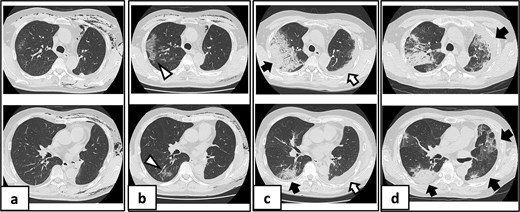 Serial chest imaging demonstrating pulmonary complications. (a) Postoperative day (POD) 10: Initial presentation without significant abnormalities. (b) POD 16: Peripheral ground-glass opacities (arrowheads). (c) POD 27: Patchy consolidation (solid arrows) with new ground-glass opacities and pleural effusion (open arrows). (d) POD 36: Progressive consolidation (solid arrows).