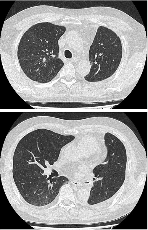 Follow-up chest imaging on postoperative Day 104 showing significant resolution of bilateral consolidations observed during the acute phase of organizing pneumonia.
