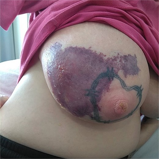 Haemorrhagic and bullous changes to right breast.