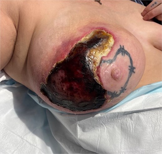 Two weeks post initial presentation, development of dry necrosis and milk leakage.