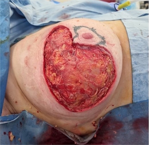 Intraoperatively, post initial debridement.