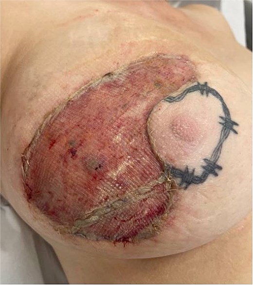 Initial postoperative skin graft.