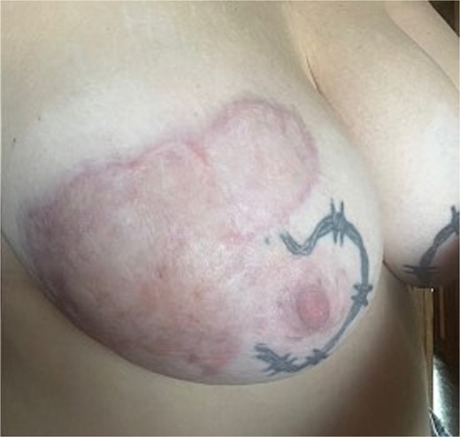 Healed skin-graft, 6 months post grafting.