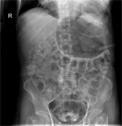 Abdominal radiograph in an anteroposterior (AP) projection demonstrates multiple dilated loops of small bowel with prominent air-fluid levels. The large bowel appears decompressed. A nasogastric tube is seen in situ, terminating in the stomach. No evidence of free intraperitoneal air is identified to suggest perforation. No radiopaque foreign bodies or mass lesions are visible.