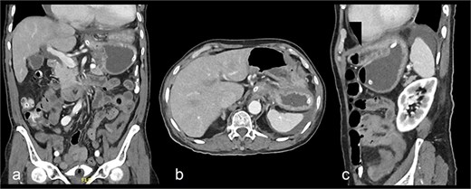 Contrast-enhanced CT abdomen and pelvis shows nasogastric (NG) tube noted in position. The stomach demonstrates abnormal orientation with inferior displacement of the fundus and superior displacement of the gastric pylorus near the gastroesophageal junction, with interval improvement of the gastric distension, likely mesenteroaxial gastric volvulus. Persistent mild perigastric and perisplenic fluid. Preserved gastric wall enhancement. Mild pelvic free fluid is noted. No free air or size significant lymph node.