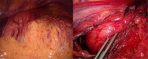 (a) Intraoperative image revealing the position of the stomach without any devitalized tissue. (b) A large hiatal hernia after completion of dissection in preparation for cruroplasty with a Toupet fundoplication.