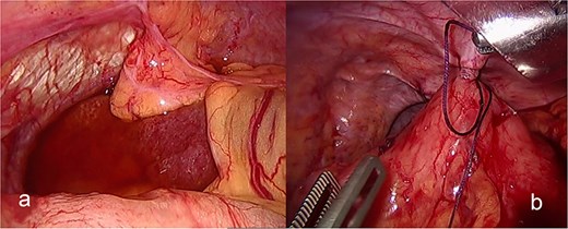 (a) The spleen appears healthy and in an abnormally mobile position, consistent with a wandering spleen, with absent or lax ligamentous attachments. (b) Postreduction view of the stomach, with its body sutured to the lateral abdominal wall (gastropexy) to prevent recurrence of mesenteroaxial gastric volvulus.