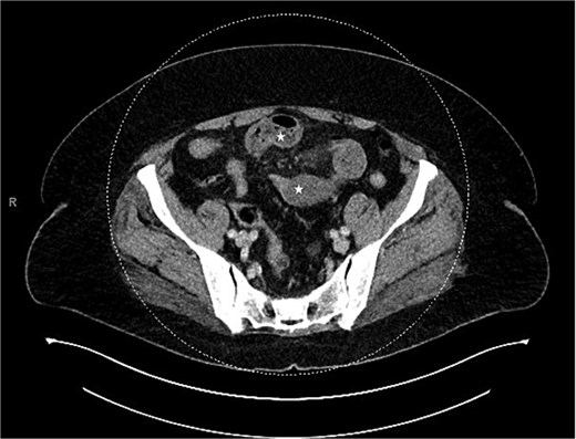 CT showing closed bowel loop obstruction and two closely positioned transition points.