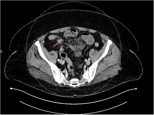 CT showing the appendix (arrow).