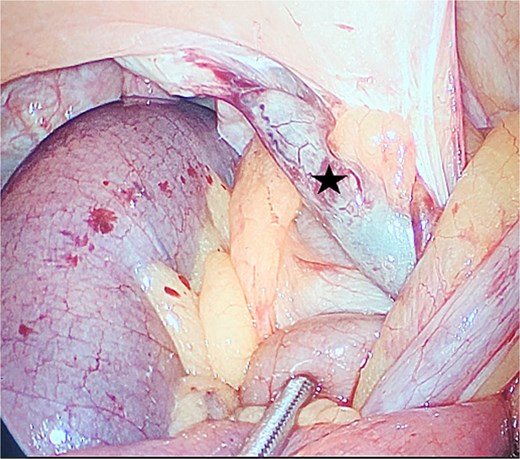 The appendix adherent to the lateral abdominal wall (star).