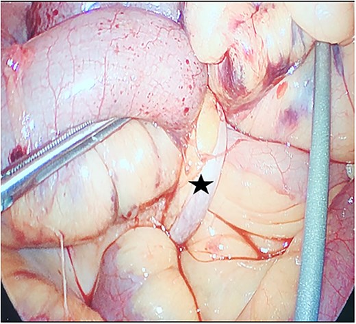The appendix forming a band around the small bowel, causing small bowel obstruction (star).