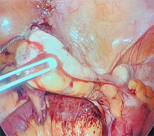 Freed appendix following lysis of adhesions.