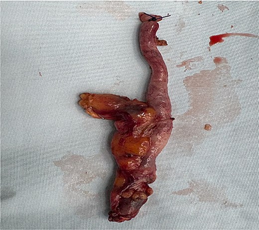 Gross specimen of the excised appendix, measuring 7 cm in length.