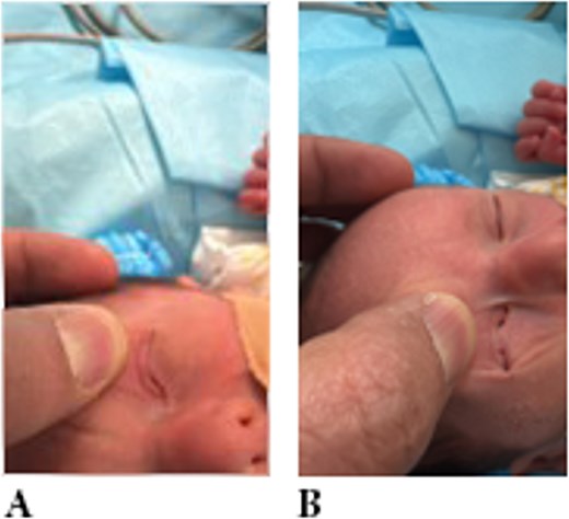 Examination showing eyelid adhesion (ankyloblepharon) in both eyes.