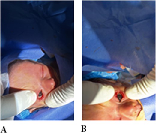 Examination showing eyelid adhesion released surgically in both eyes.