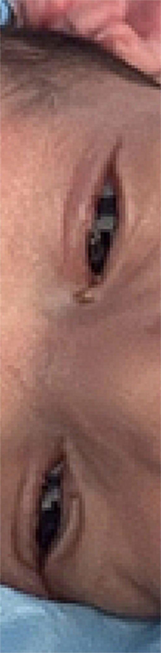 Patient first day post-op showing eyelids freely separated.